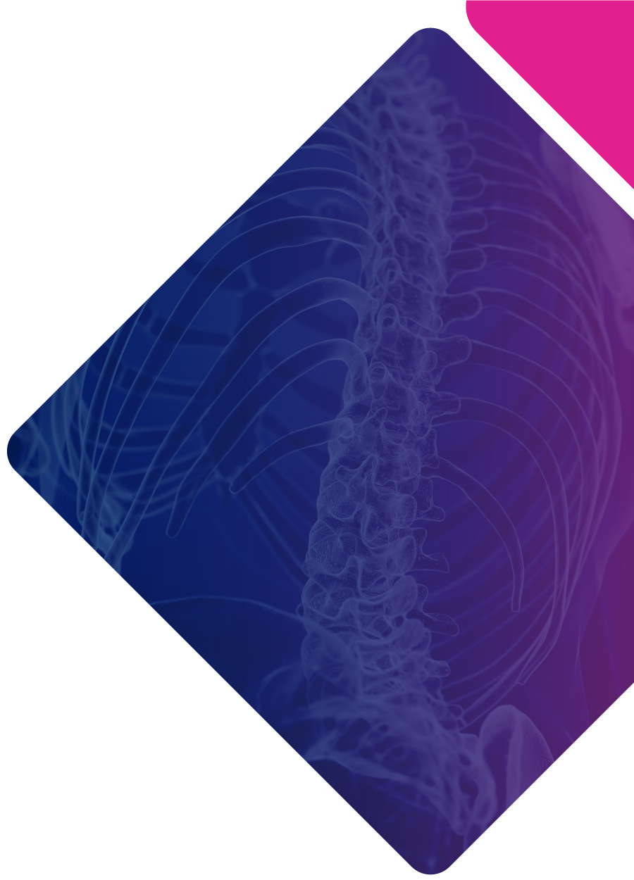 Via Disc Degenerative Disc Treatment Allograft Vivex